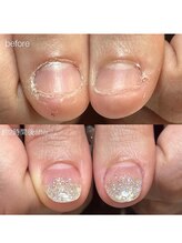 ティアラネイル 宇都宮/深爪矯正