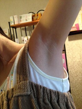 ソワンヌ/脱毛デビューの方におすすめ