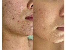 リレア ラカ(Relair Laka)/ハーブピーリング