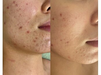 リレア ラカ(Relair Laka)/ハーブピーリング