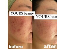 ユアーズ ビューティー(YOURS beauty)/棘あり☆１回