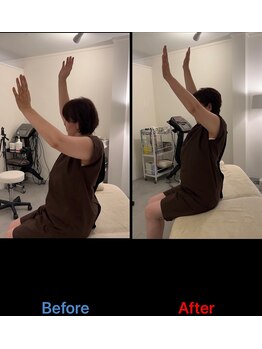 銀座鍼処 カナウ(KANAU)/上がらない肩痛改善例（女性）