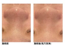 オーシャンブルー 福岡店(OCEAN BLUE フェイシャル&ボディ)/毛穴の黒ずみケア（毛穴洗浄）