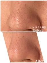 アカヌケ(AKANUKE)/黒ずみ毛穴ケアでニキビ改善