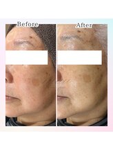 ムゥ(muu)/【美容液導入】