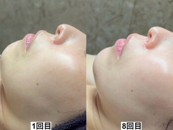 ドロップ 天王寺(DROP)/ララピール【艶肌/美白/くすみ】