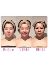 TKC 東京小顔センター五反田店/ビフォーアフター【むくみ改善】