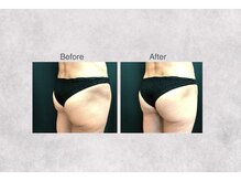 ミセル 尾道店(MYTHEL)/before　after　お尻