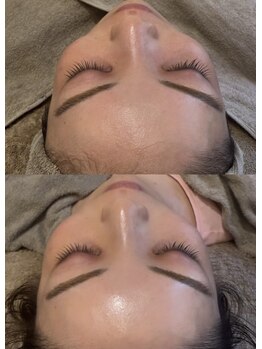 マホロバ(mahoroba)/毛穴洗浄+美容鍼で艶肌