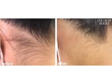 シフォン(Chiffon)/うなじ脱毛　before★after　1