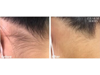 シフォン(Chiffon)/うなじ脱毛　before★after　1