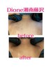 ☆キレイな背中〈脱毛×背中ニキビケア〉☆6,600→3,300円
