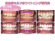 エクシア ホワイトニング 鶴岡店/ビフォーアフター
