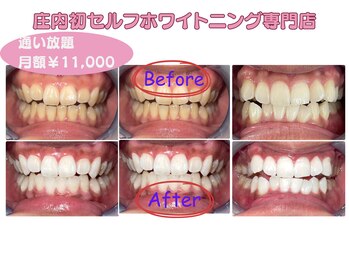 エクシア ホワイトニング 鶴岡店/ビフォーアフター