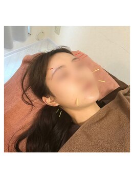 リー(Re)/施術例【美容鍼】