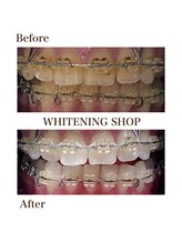 ホワイトニングショップ 岸和田店/お客様のBefore  After