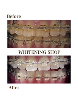 ホワイトニングショップ 岸和田店/お客様のBefore  After