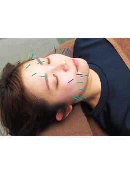 鍼灸施術を受けたい