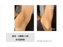 ラレピア(LA LEPIA)/お客様BeforeAfter☆