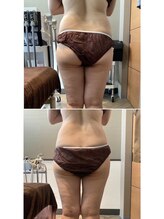 フォビィサロン(FOBE...salon)/冷却痩身