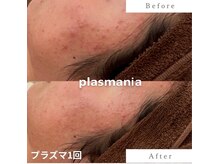 アールスタイルビューティ(R STYLE BEAUTY)/プラズマハ-ブピ-リング赤ニキビ