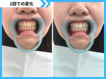 鹿児島ホワイトニング/Before→After
