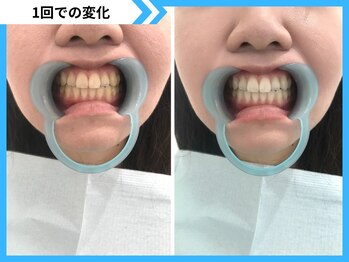 鹿児島ホワイトニング/Before→After