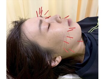 今福鶴見わだち整骨院の写真/ニキビケア・シワたるみ改善や小顔など、お顔の血行促進でいつもの化粧水が入りやすいお肌に◎【美容鍼】