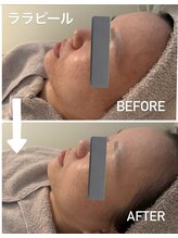 カエラ(KAELA)/ララピール