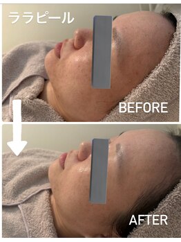 カエラ(KAELA)/ララピール