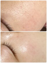 アスピリア(aspirer a')/ハーブピーリング