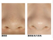 オーシャンブルー 福岡店(OCEAN BLUE フェイシャル&ボディ)/毛穴黒ずみ＆開きケア