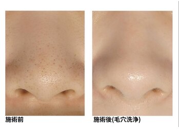 オーシャンブルー 福岡店(OCEAN BLUE フェイシャル&ボディ)/毛穴黒ずみ＆開きケア