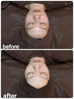 ウララ(ulala)/セラピール1回目