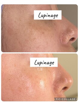 ルピナージュ(Lupinage)/【肌質改善】‐目のたるみケア‐