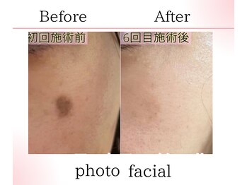 サロンツキ(salon tuki)/光フォト症例/徳島シミケア