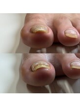 リリ(lili)/巻き爪矯正/1回目