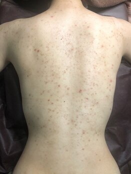 ココティー 大阪店(Cocotii)の写真/グリーンピールボディ背中上部or下部(各A4サイズ)¥33000→¥26400/背中全体(A4サイズ×2)¥66000→¥52800◎