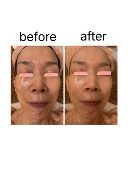 リリー(Rily)の写真/【くすみ・毛穴・たるみ改善】オールハンド×毛穴吸引フェイシャル60分 4,950円