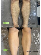 ディオラビューティーサロン(Diora)/剛毛な男性の施術経過