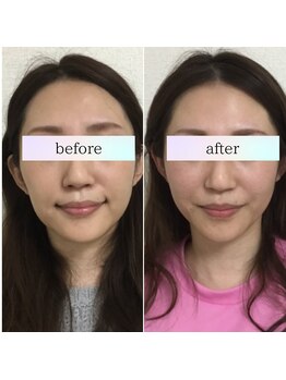 小顔革命 小顔 全身美容矯正専門店/小顔矯正+顎関節矯正