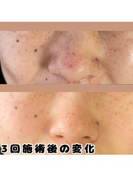 マール(MARL.)/シミケア初回5000円