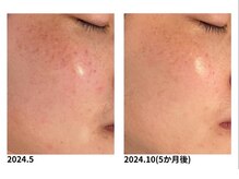 オーシャンブルー 福岡店(OCEAN BLUE フェイシャル&ボディ)/シミ・くすみケア