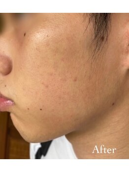 ルナカーザ(LUNACASA)/VOSニキビケア After