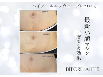 ユアーズ ビューティー(YOURS beauty)/気になる二重顎にもアタック☆