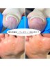 《初回限定》巻き爪補正１ヶ所＋魚の目ケア１ヶ所｜原因分析＋再発予防ケア付