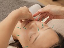 ＊美容鍼施術中＊