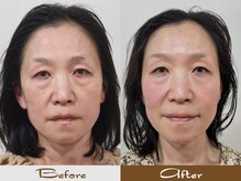 ハカハカ(HAKA HAKA)/美容頭蓋小顔矯正90分