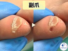 プラスワンフット 本厚木(+1 Foot)/小指の副爪の下に隠れていた鶏眼