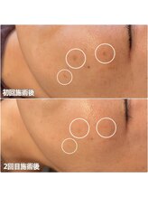 クレアナ ザ ビューティー(KULEANA the beauty)/光フォト